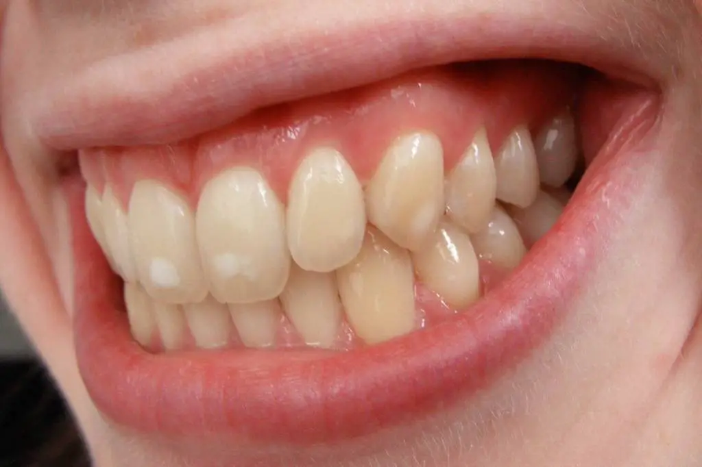 Fluoroza Zuba (Bele Mrlje na Zubima)