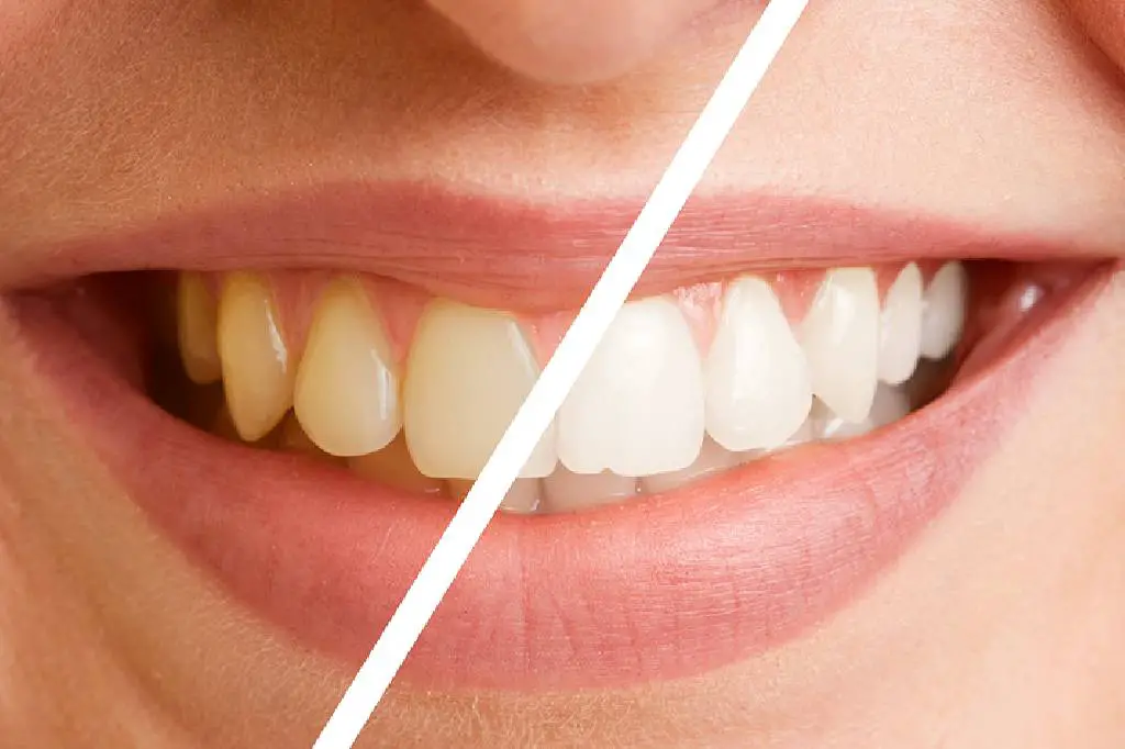 zubi pre i posle peskiranja